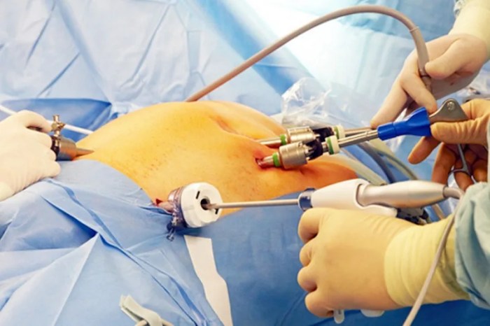 Surgical freeing of a kidney from adhesions